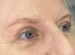 Combination Surgeries (eyelid lift and other)