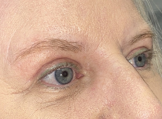 Combination Surgeries (eyelid lift and other)