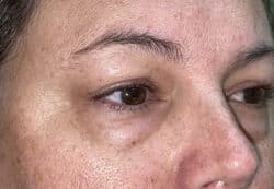 Upper/Lower Lid Blepharoplasty