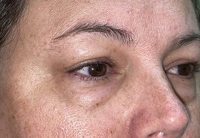 Upper/Lower Lid Blepharoplasty