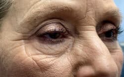 Eyelid Lift (Blepharoplasty/Ptosis Repair)