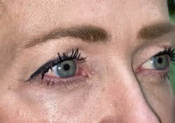 Brow/Forehead Lift