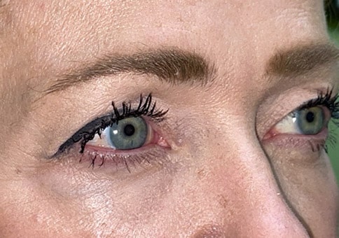 Brow/Forehead Lift