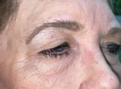 Combination Surgeries (eyelid lift and other)