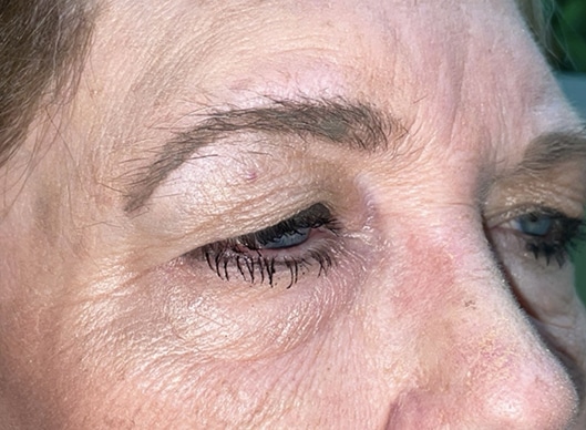 Combination Surgeries (eyelid lift and other)