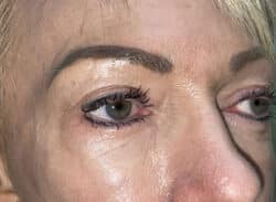 Combination Surgeries (eyelid lift and other)