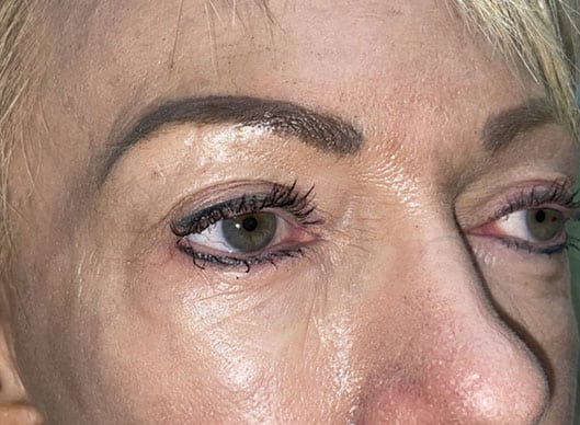 Combination Surgeries (eyelid lift and other)
