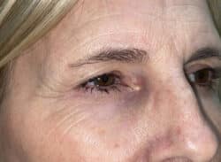 Combination Surgeries (eyelid lift and other)