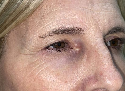 Combination Surgeries (eyelid lift and other)