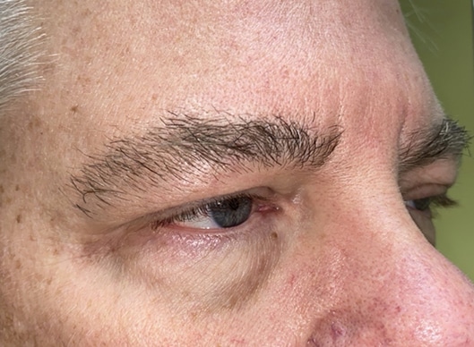 Combination Surgeries (eyelid lift and other)