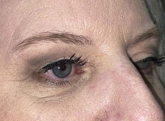 Combination Surgeries (eyelid lift and other)