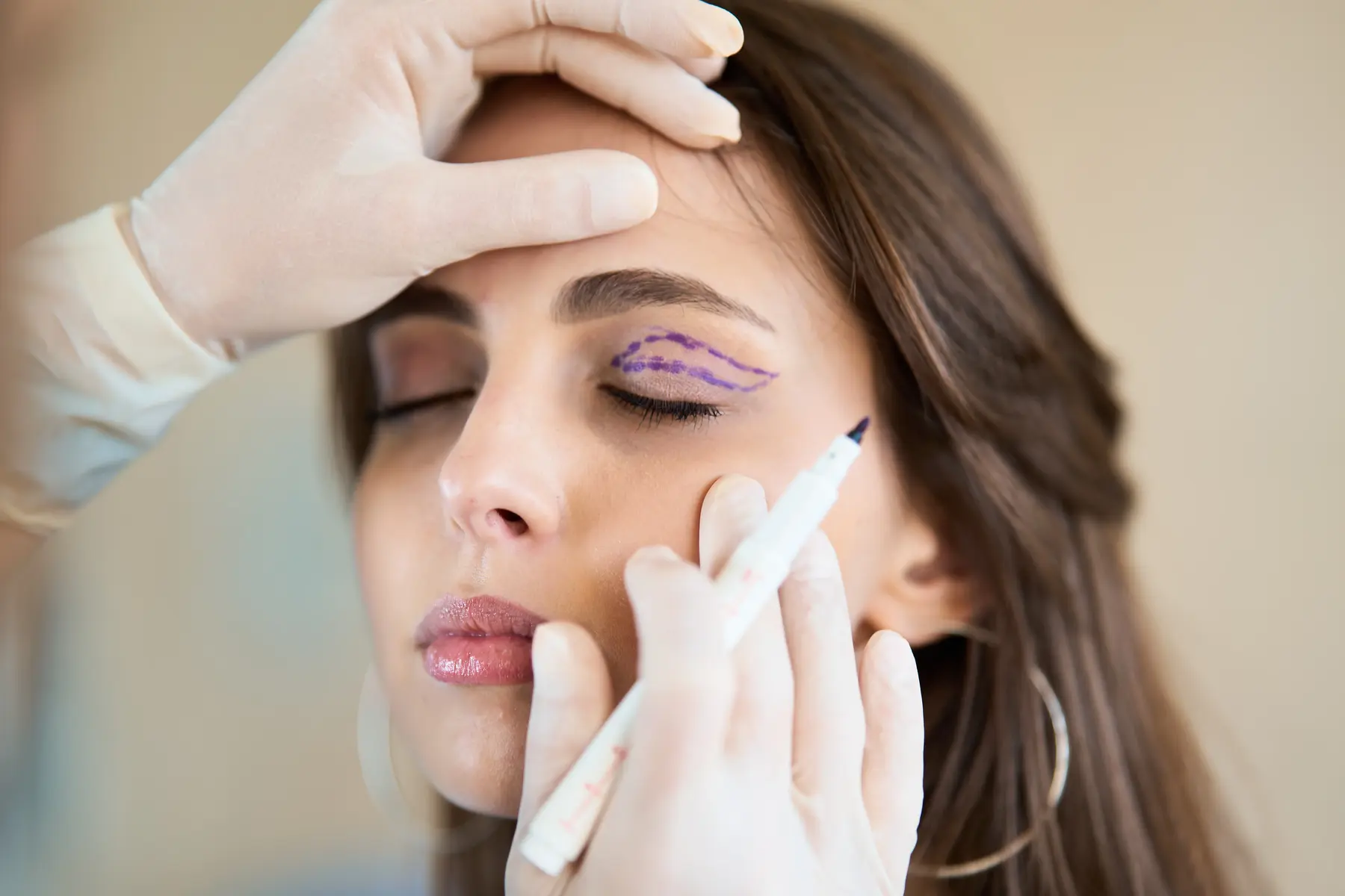 Brow Lift 4 Surgeon marking woman's eyelid for cosmetic procedure