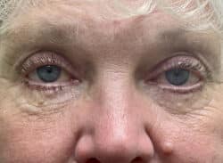 Combination Surgeries (eyelid lift and other)