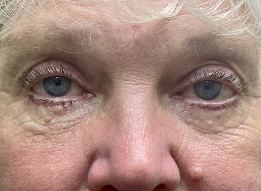 Combination Surgeries (eyelid lift and other)