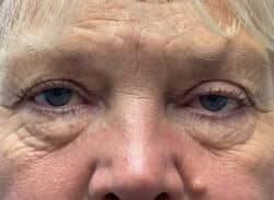 Combination Surgeries (eyelid lift and other)
