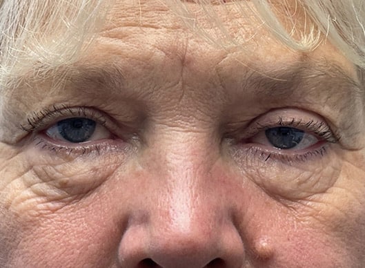 Combination Surgeries (eyelid lift and other)