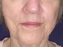 Combination Surgeries (eyelid lift and other)