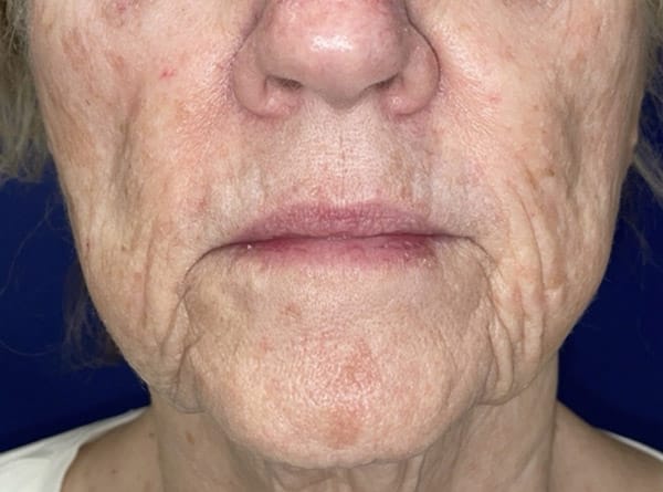 Combination Surgeries (eyelid lift and other)
