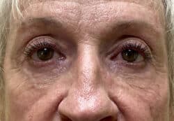 Lower Lid Blepharoplasty (lower eyelid eyelift)