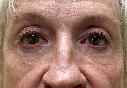 Lower Lid Blepharoplasty (lower eyelid eyelift)
