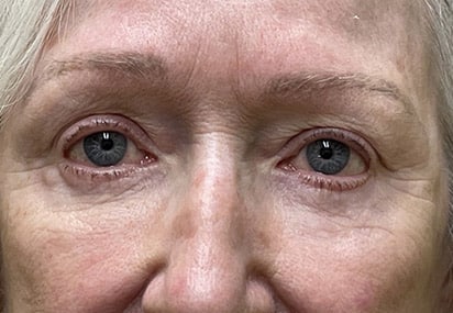Lower Lid Blepharoplasty (lower eyelid eyelift)