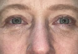 Upper/Lower Lid Blepharoplasty