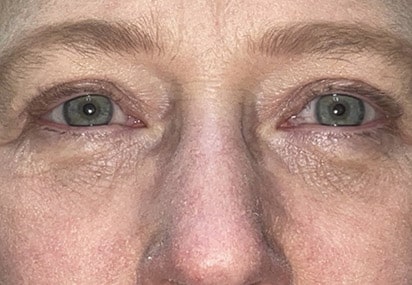 Upper/Lower Lid Blepharoplasty