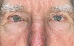 Eyelid Lift (Blepharoplasty/Ptosis Repair)