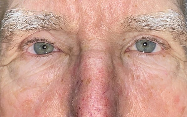 Eyelid Lift (Blepharoplasty/Ptosis Repair)