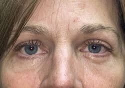 Brow/Forehead Lift