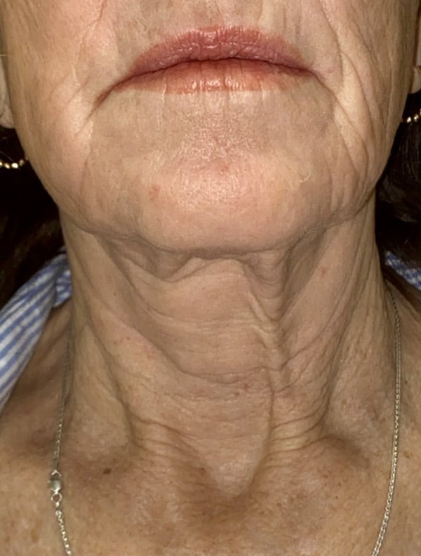 CO2 Laser Resurfacing (wrinkle/line reduction)