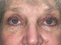 Combination Surgeries (eyelid lift and other)