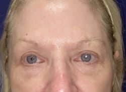 Combination Surgeries (eyelid lift and other)