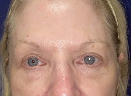 Combination Surgeries (eyelid lift and other)