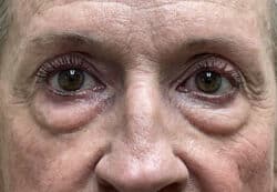 Lower Lid Blepharoplasty (lower eyelid eyelift)