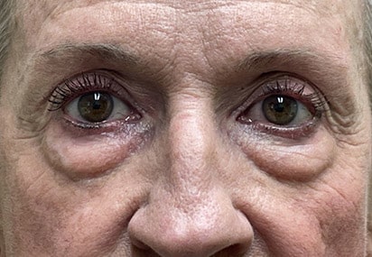 Lower Lid Blepharoplasty (lower eyelid eyelift)