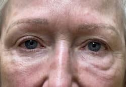 Lower Lid Blepharoplasty (lower eyelid eyelift)