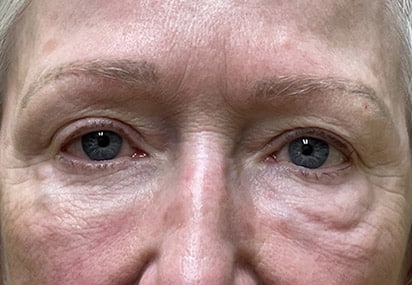 Lower Lid Blepharoplasty (lower eyelid eyelift)