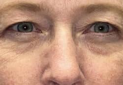 Upper/Lower Lid Blepharoplasty