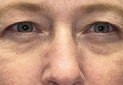 Upper/Lower Lid Blepharoplasty