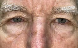 Eyelid Lift (Blepharoplasty/Ptosis Repair)