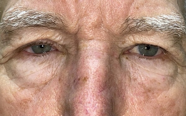 Eyelid Lift (Blepharoplasty/Ptosis Repair)