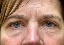 Brow/Forehead Lift
