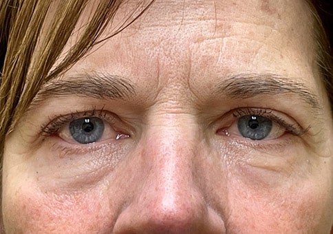 Brow/Forehead Lift