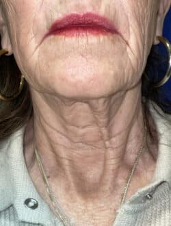 CO2 Laser Resurfacing (wrinkle/line reduction)