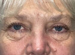 Combination Surgeries (eyelid lift and other)