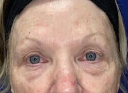 Combination Surgeries (eyelid lift and other)