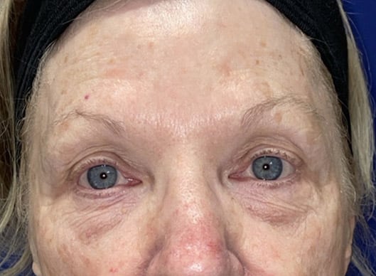 Combination Surgeries (eyelid lift and other)