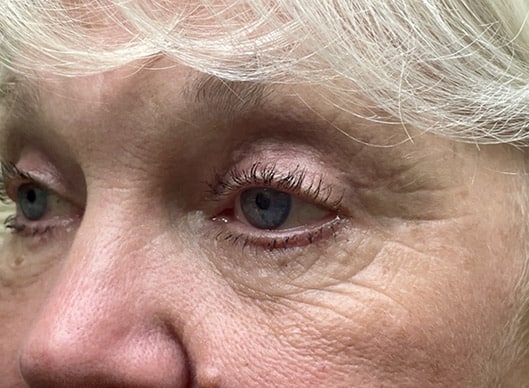 Combination Surgeries (eyelid lift and other)