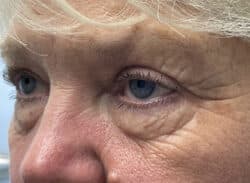 Combination Surgeries (eyelid lift and other)